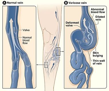 Levicose restores the walls of blood vessels