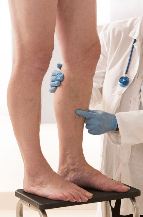 What is varicose