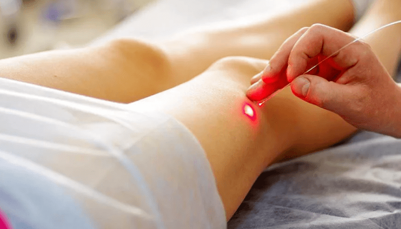 Laser lagula of varicose veins