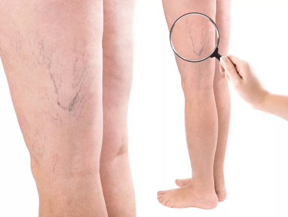 Varicosis veins in women