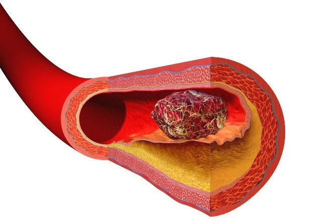 thrombuz