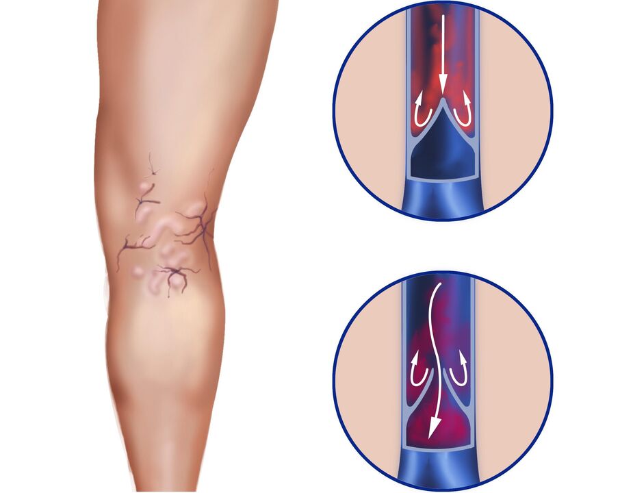 What happens in the veins for varicose veins