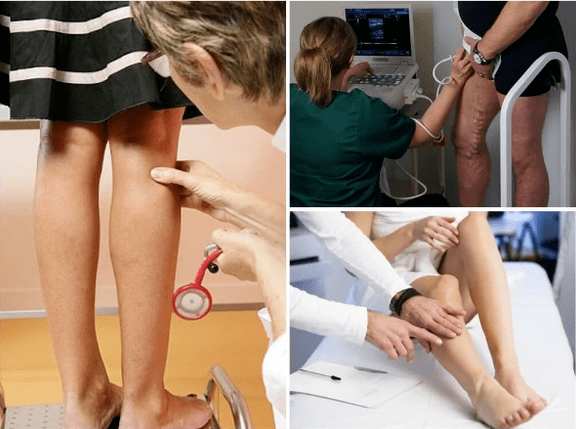 Varicosis veins in the legs