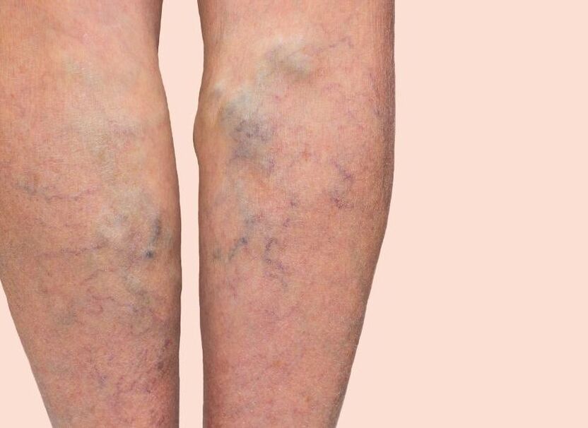 What varicose veins look like
