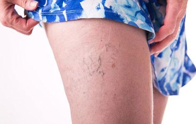 Varicosis veins on the foot