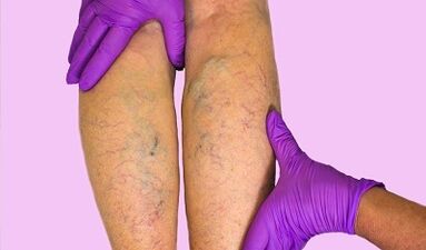 What can do with varicose veins and cannot be done