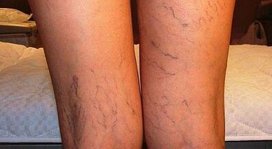 How can women be treated in women's varicon expansion