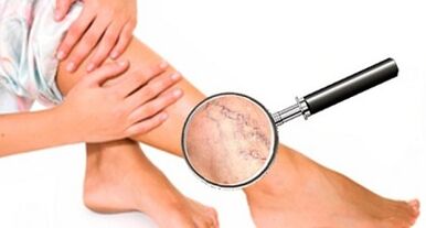 Reasons for varicose veins