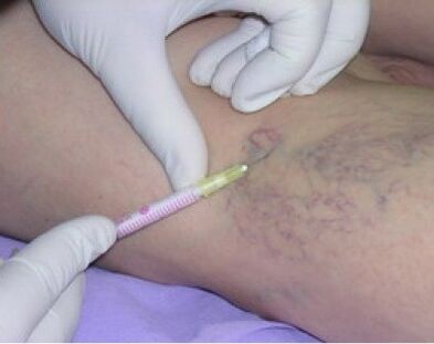 Injection for varicose veins