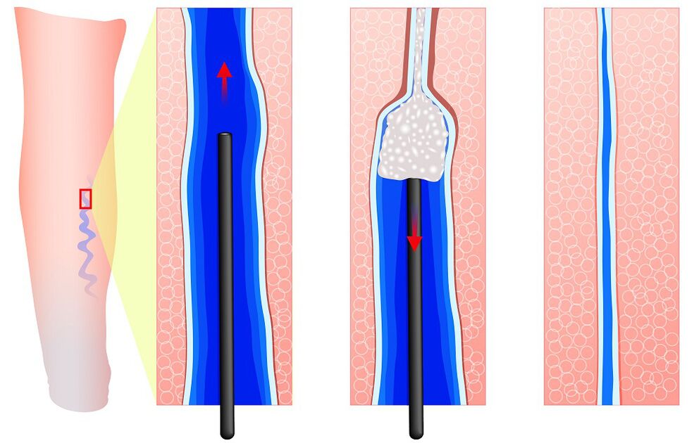 The mechanism of sclerotherapy