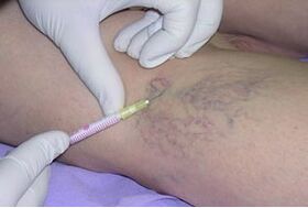 Sclerotherapy is a method of treating varicose veins in the legs