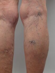 Varicose veins of the lower extremities and tortuous veins protrude above the surface of the skin. 