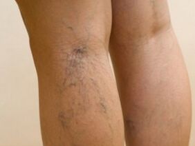 Veins protruding from under the skin are a sign of varicose veins in the legs