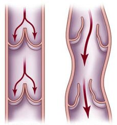 Violation of blood flow in healthy veins and varicose veins