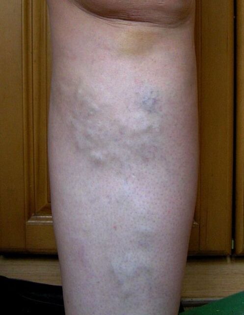 Swollen veins in the leg due to varicose veins